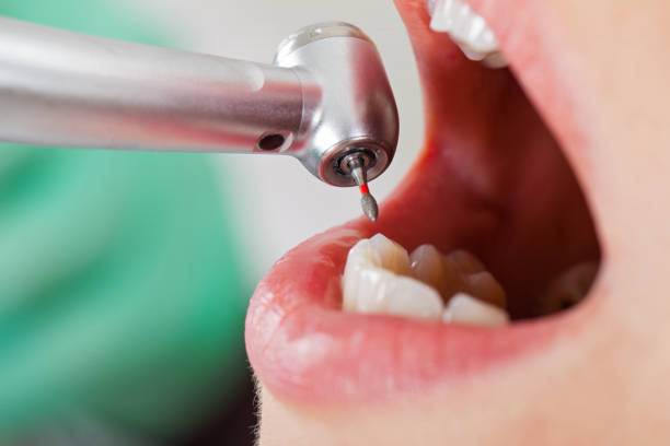 Best Emergency Treatment for Dental Infections or Abscesses in Eastwood, MI